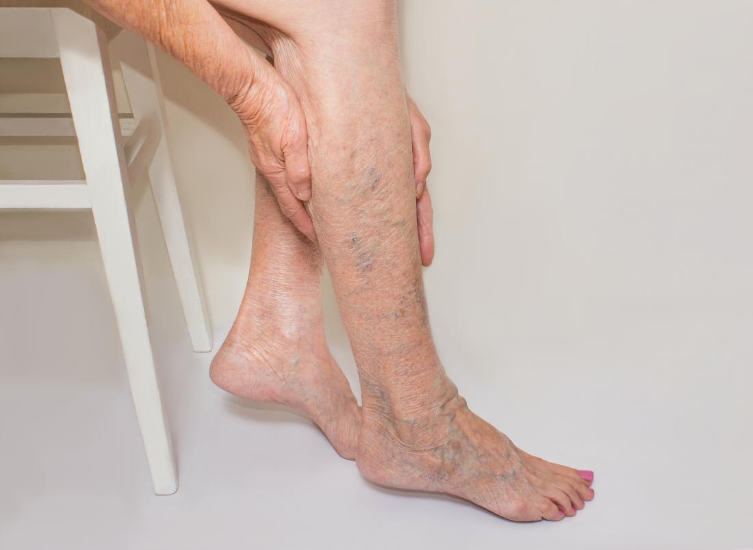 Suy giãn tĩnh mạch chân và các triệu chứng thường gặp