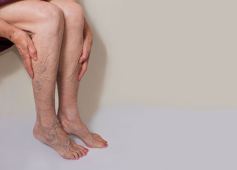 70% nữ giới bị suy giãn tĩnh mạch chân: Chuyên gia Bệnh viện Việt Đức khuyến cáo gì?