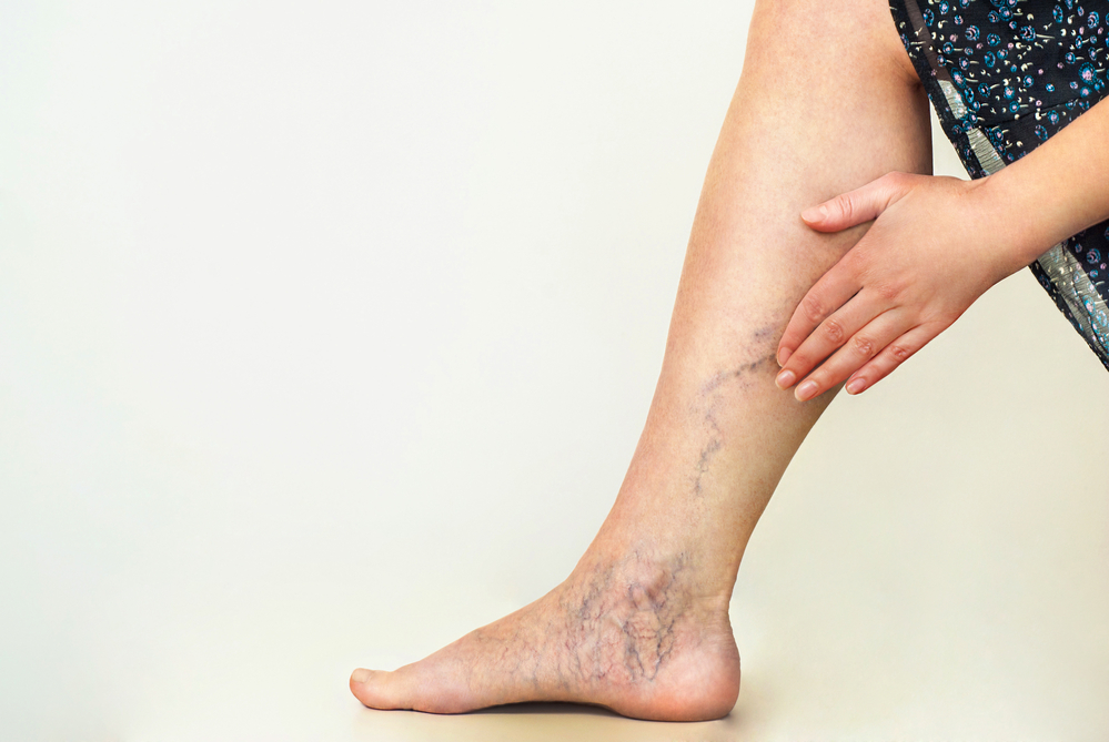 Suy giãn tĩnh mạch bàn chân và cách khắc phục