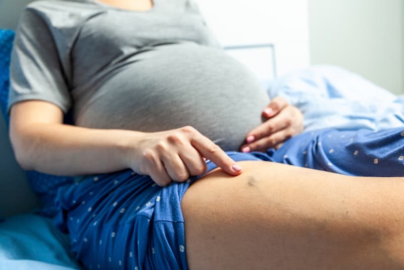 Suy giãn tĩnh mạch khi mang thai khi nào thì biến mất?