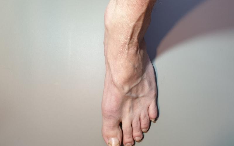 Nổi gân xanh ở chân có thể là hiện tượng bình thường hoặc là biểu hiện của các bệnh lý 
