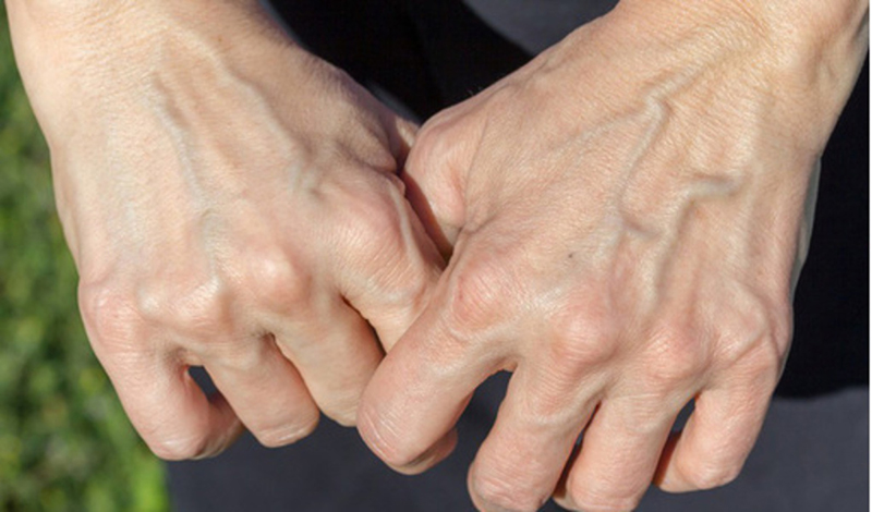 Nổi mạch máu ở tay có thể do suy giãn tĩnh mạch gây nên
